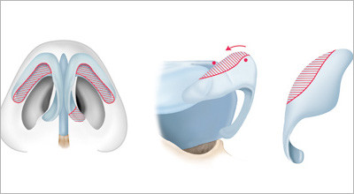 1. Rhinoplastik – Die Eversionstechnik