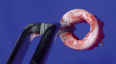 Einzeitig behandeln mit Knochenringen