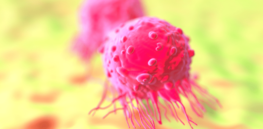 Parodontitispatienten haben erhöhtes Brustkrebsrisiko