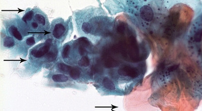 Risikoläsionen der Mundhöhlenschleimhaut