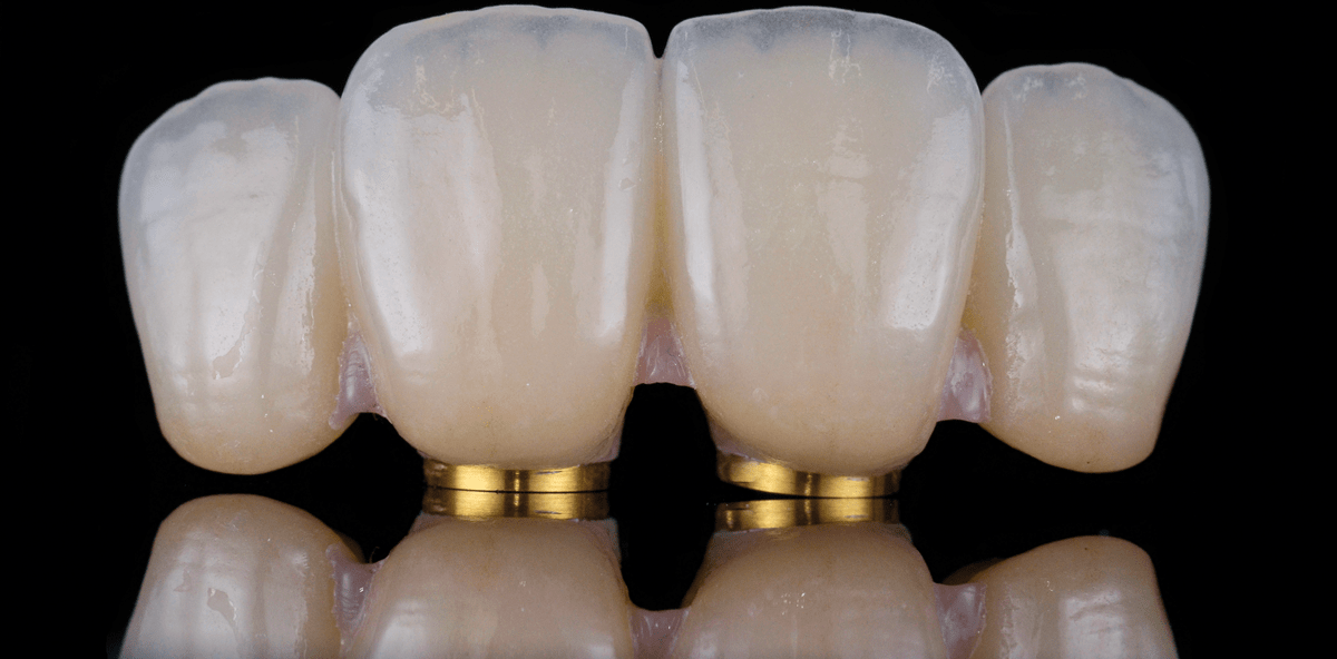 Мосты с напылением Мосты с напылением