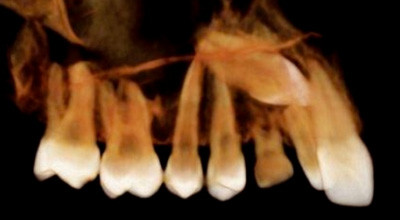Röntgen in der KFO – analog, digital und 3-D (1)