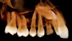 Röntgen in der KFO – analog, digital und 3-D (1)