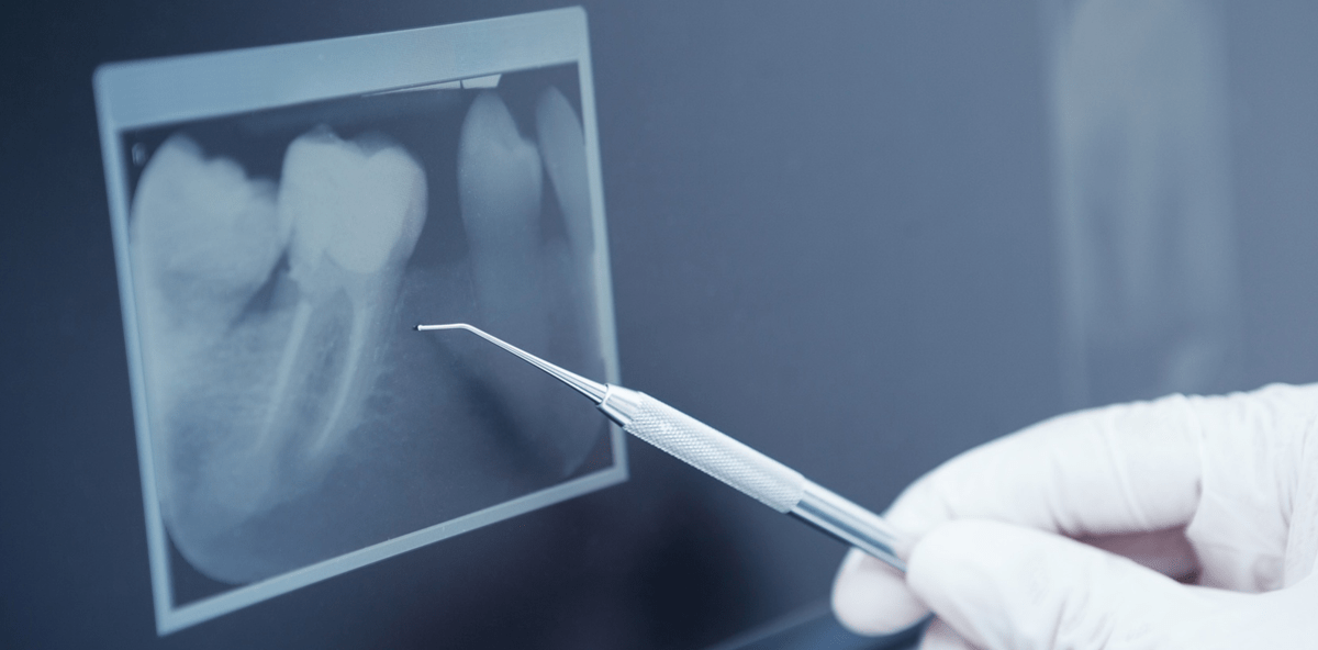 Röntgen im Mundraum: Nicht mehr als unbedingt nötig