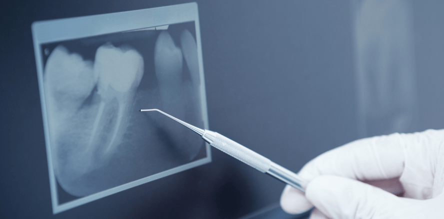 Röntgen im Mundraum: Nicht mehr als unbedingt nötig