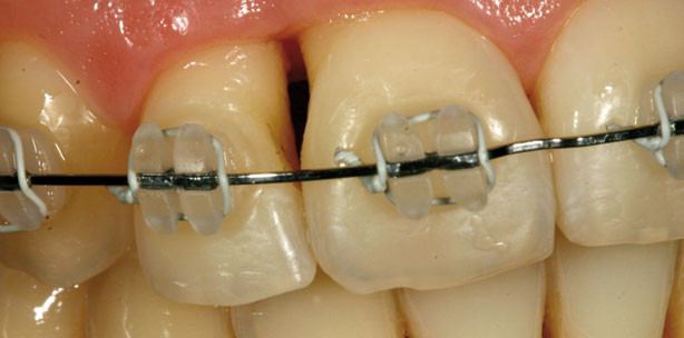 Rote Ästhetik und KFO – Ein starkes Team!
