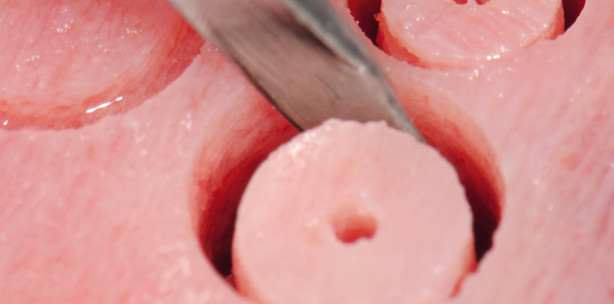 Minimalinvasive alveoläre Knochenaugmentation