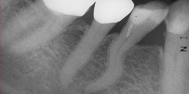 S-förmiger Kanalverlauf – Herausforderung in der Endodontie