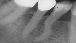 S-förmiger Kanalverlauf – Herausforderung in der Endodontie