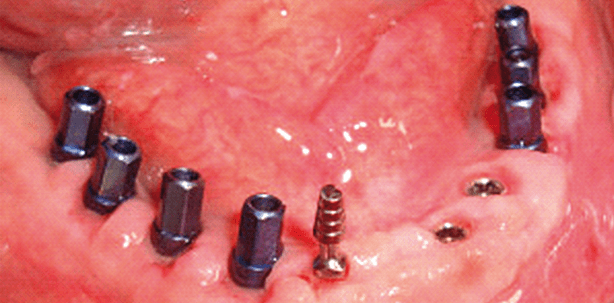 Straightforward Advanced Complex in der Implantologie