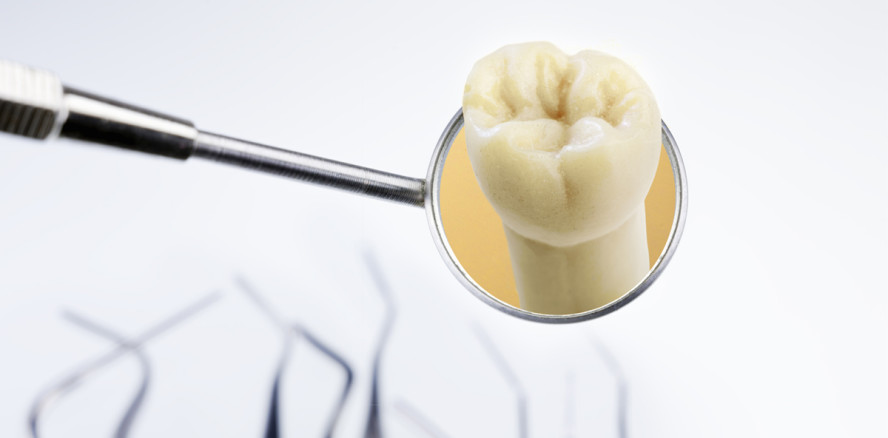 Zähne mit Säureschäden schonend und effizient behandeln