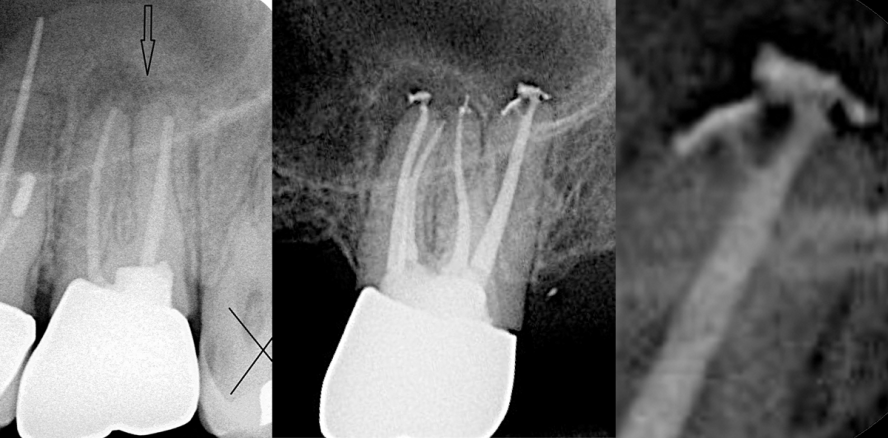 SAF-System – Teil 5: Revisionsbehandlung und Obturation ovaler Kanäle