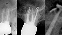 SAF-System – Teil 5: Revisionsbehandlung und Obturation ovaler Kanäle