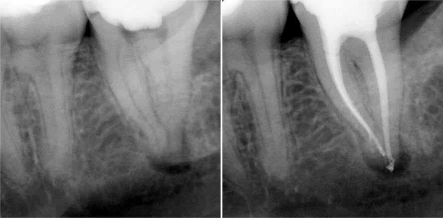 SAF-System – Teil 6: Ein neues ­mikroinvasives endodontisches Behandlungskonzept