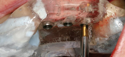 Digitale Techniken für eine effektive Bohrschablonenherstellung