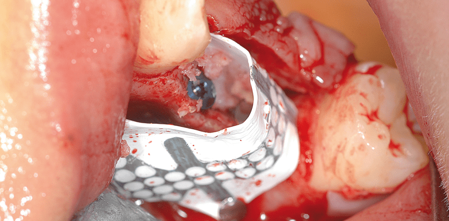 Regeneration eines schmalen Kieferkamms mit titanverstärkter Membran und Implantaten