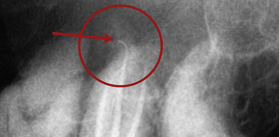 Endodontische Schmerzbehandlung an Molaren