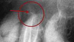 Endodontische Schmerzbehandlung an Molaren