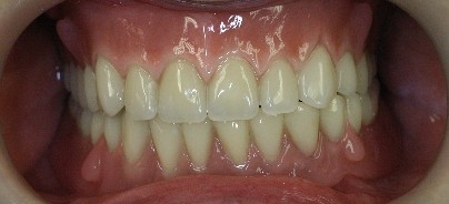 Lebensqualität im Alter durch Implantate