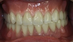 Lebensqualität im Alter durch Implantate