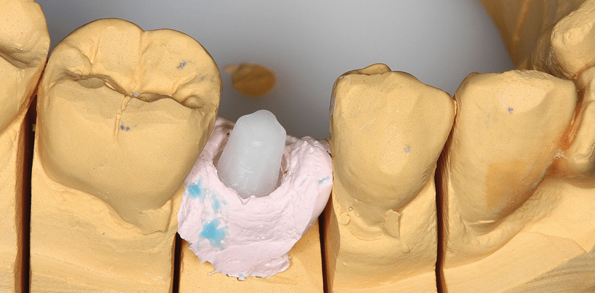 Keramikimplantate als Ergänzung des Therapiespektrums
