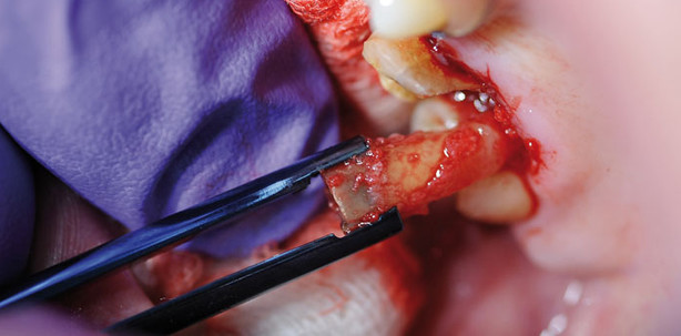 Knochen- und Gewebeschonung bei der Zahnextraktion