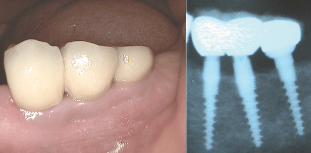 Feste Zähne an einem Tag: Kontrolle nach fünf Jahren