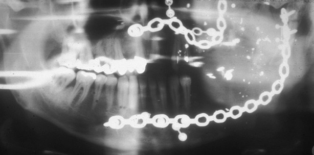 Schussverletzung im Kiefer-Gesichtsbereich