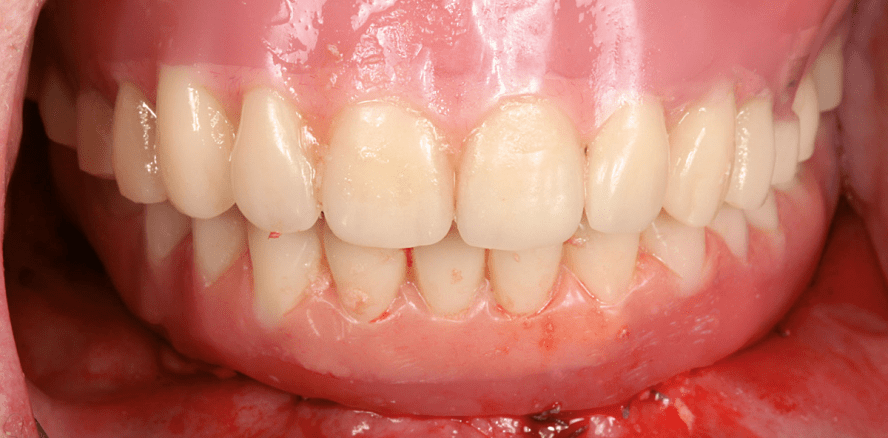 Intraorales Schweißen einer Gerüstkonstruktion