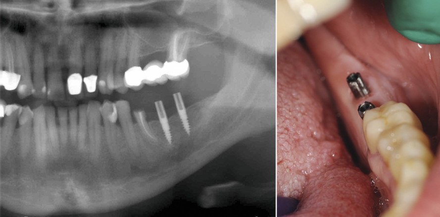 Einteilige Implantatversorgung eines einseitigen Freiendfalls im Unterkiefer