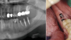 Einteilige Implantatversorgung eines einseitigen Freiendfalls im Unterkiefer
