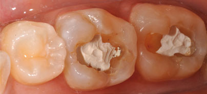 Füllungen in einem Schritt: Heute schon Realität?