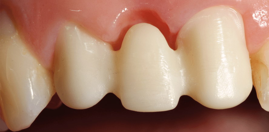 Monolithische Vollkeramikrestaurationen im Seitenzahnbereich