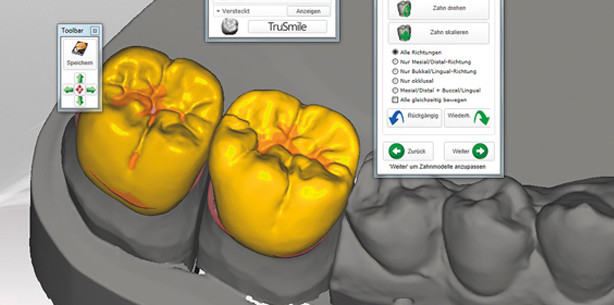 In kurzer Zeit mit CAD/CAM zur Seitenzahnkrone