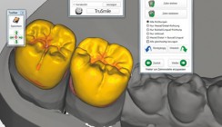 In kurzer Zeit mit CAD/CAM zur Seitenzahnkrone