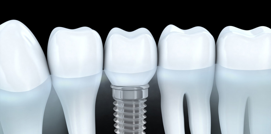 Studie zu Implantaten belegt: Kein erhöhtes Risiko bei älteren Patienten