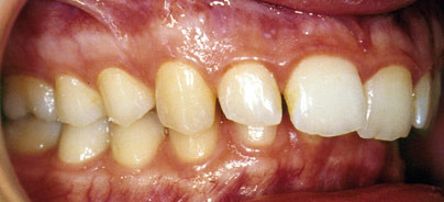 Untergesichtsverlängerung bei Klasse II-Dysgnathien mit Short-face