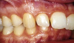 Untergesichtsverlängerung bei Klasse II-Dysgnathien mit Short-face