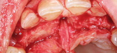 Jetzt oder später? – Grenzfälle der ästhetischen Sofortimplantation