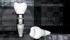 Nano-Silber verbessert Implantate