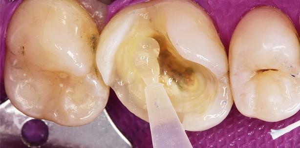 Zirkonoxidverstärkte Silikatkeramik in der Anwendung