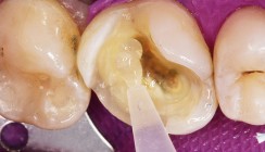Zirkonoxidverstärkte Silikatkeramik in der Anwendung