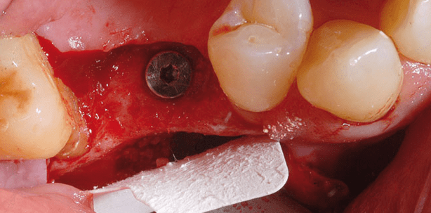 Simultaner Sinuslift als praxistaugliches Konzept auch in Grenzfällen
