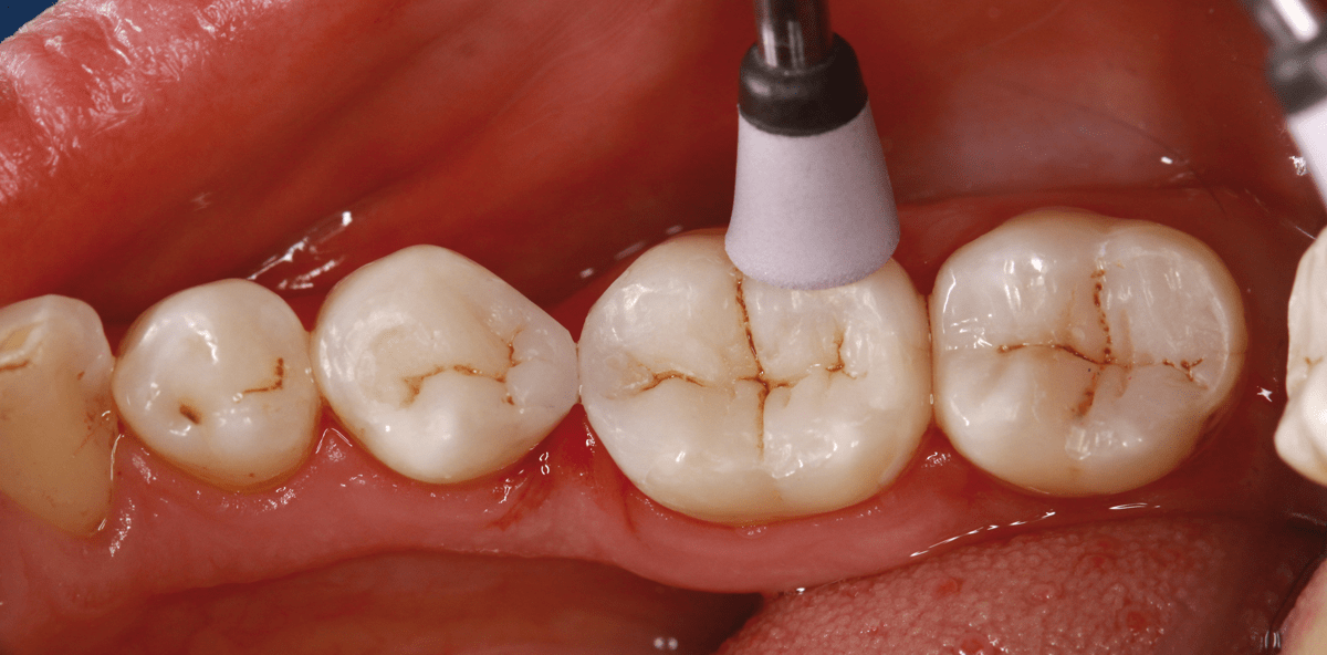 Ästhetische „Single-Shade“-Restauration ohne Kompromisse