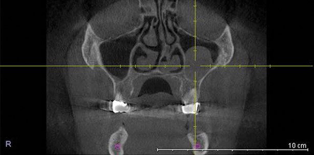 Implantationsrelevante Erkrankungen der Kieferhöhle