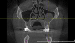 Implantationsrelevante Erkrankungen der Kieferhöhle