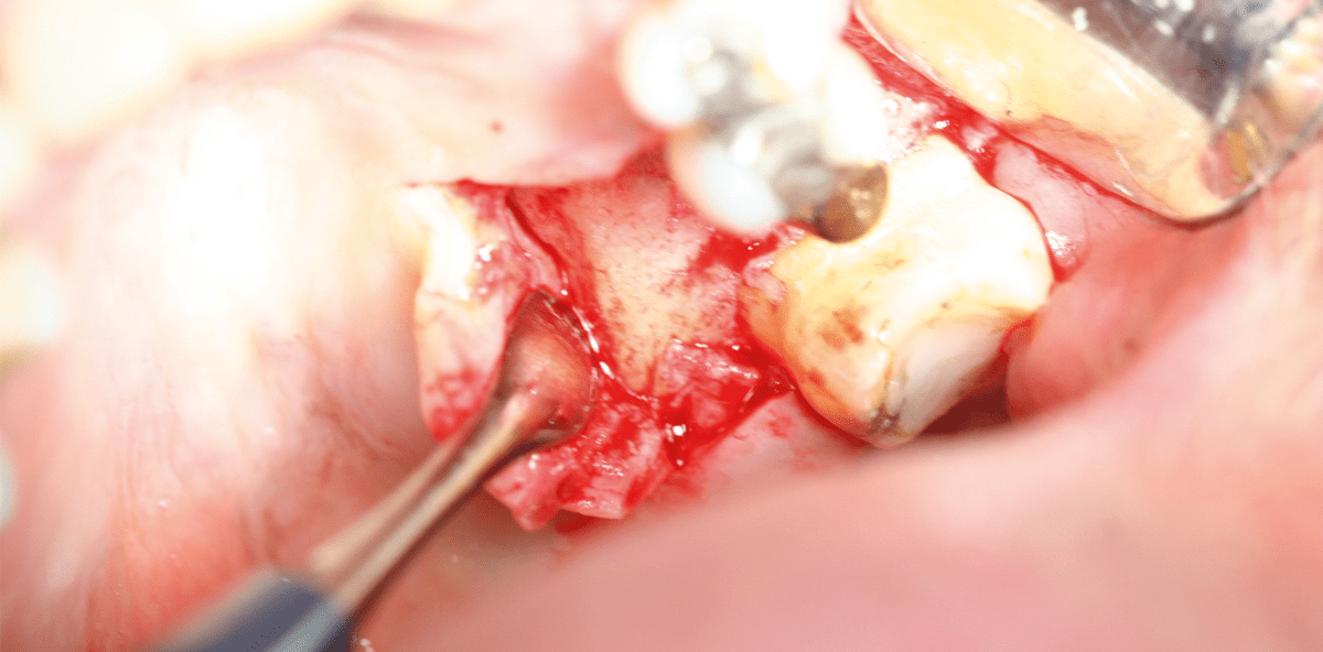Interner Sinuslift ohne Graft-Material