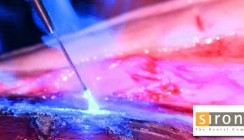 DGL-Tagung: SIROLaser Blue überzeugt Anwender und Kongressteilnehmer