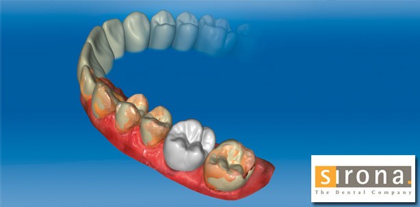 CEREC Premium SW 4.4: Mehr Möglichkeiten für Ihr Praxislabor