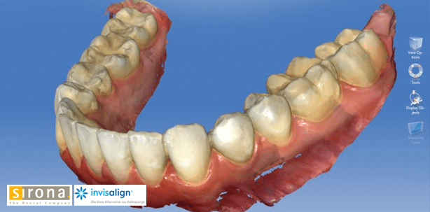 CEREC meets Invisalign®